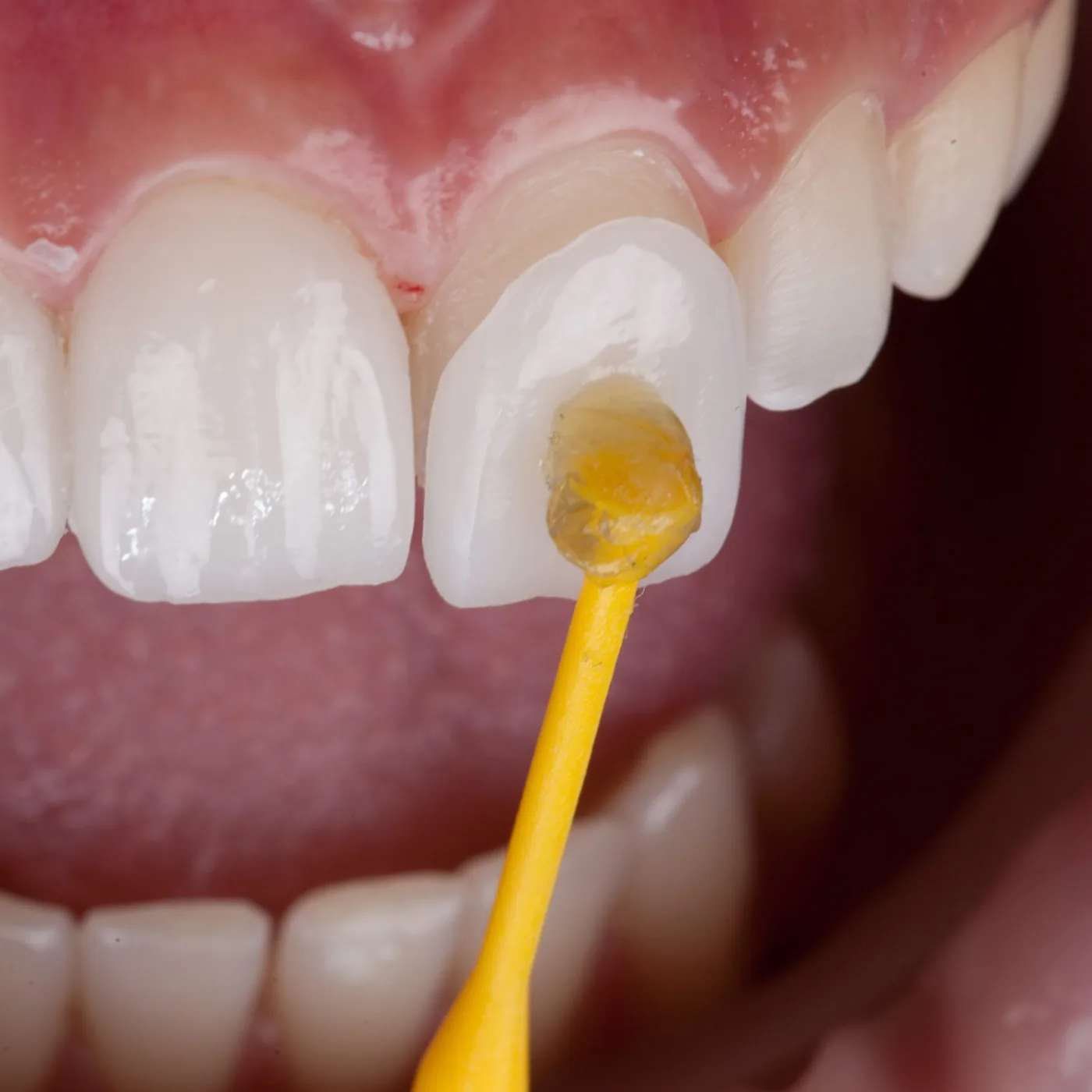 Porcelain veneers to correct dental imperfections in Warren, OH